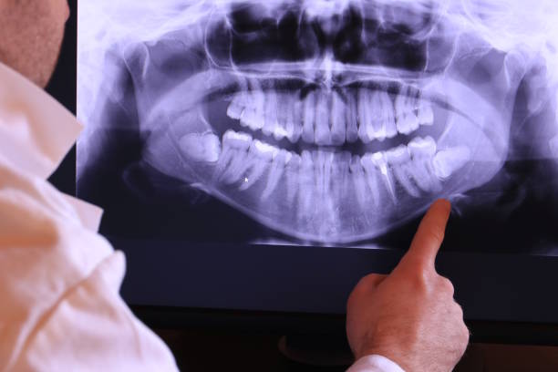 Best Emergency Wisdom Teeth Removal in Sweeny, TX